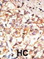 Immunohistochemistry of human hepatocarcinoma (HC) tissue showing specific staining of CD133.