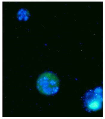 Figure 1. Fluorescent Microscopy Analysis of THP-1 Suspension Cells THP-1 cells were stained with Poly (active) Caspase FAM FLICA® Inhibitor Reagent (green), and Hoechst 33342 (Blue). Cells were incubated with staurosporine to induce apoptosis. Two photos were taken and superimposed. Only one cell of the three cells is apoptotic (middle) – it is stained positive for caspase activity with FAM-VAD-FMK. Data courtesy of Dr. Brian W. Lee.