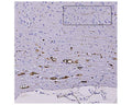 Image of formalin-fixed paraffin-embedded sections of a mouse model of ALS (Acta Neuropathol. 2016 Jan; 131(1): 103-114) by Immunohistochemistry. The section was stained with M-2122-50, Neurofilament light polypeptide (NF-L), DG-Sensor™, Clone 6H63, Mouse mAb. These heterozygous G85R-SOD1-YFP mice do not develop ALS unless primed with mutant SOD1 aggregates, indicating that this is a model of prion induction of pathogenesis. Degenerated processes were seen in the sciatic nerve, spinal cord fibers, and, as shown here, the brain stem, after this mouse was injected with mutant SOD1. Take note of the swollen and sinusoidal profiles. The inset depicts a beaded profile typical of degenerating processes.