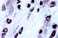 Detection of capsaicin receptor in small neurons in rat dorsal root ganglion (DRG) using rabbit antibody to human capsaicin receptor (608-621): whole serum, catalogue number R-076-100, at 1:2000 dilution. The rat tissue was prepared by perfusion fixation with 4% formaldehyde containing 10% saturated picric acid in buffered saline. Frozen sections (40 µm) were used and the secondary antibody was conjugated with HRP. Rat spinal cord prepared in the same way also shows a high specific stain with little background.