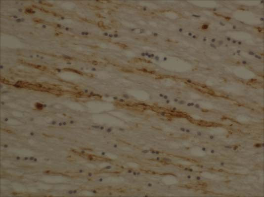 Immunohistochemistry on human brain with brain trauma (car accident), using rabbit antibody to guinea pig degraded myelin basic protein (68-86): whole serum (R-107-100) at a dilution of 1:2000. Courtesy of Dr. Wei-Ping Gai, The Flinders University of South Australia.