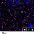 Array tomography immunofluorescence of a Lowicryl-embedded 70 nm section from adult mouse cortex with L120/12 (green), rabbit mAb GAD2 (Cell Signaling 5843, magenta) and DAPI (blue). The insert shows three consecutive sections through the synapse that is marked with a white box. Image courtesy of Kristina Micheva (Stanford).