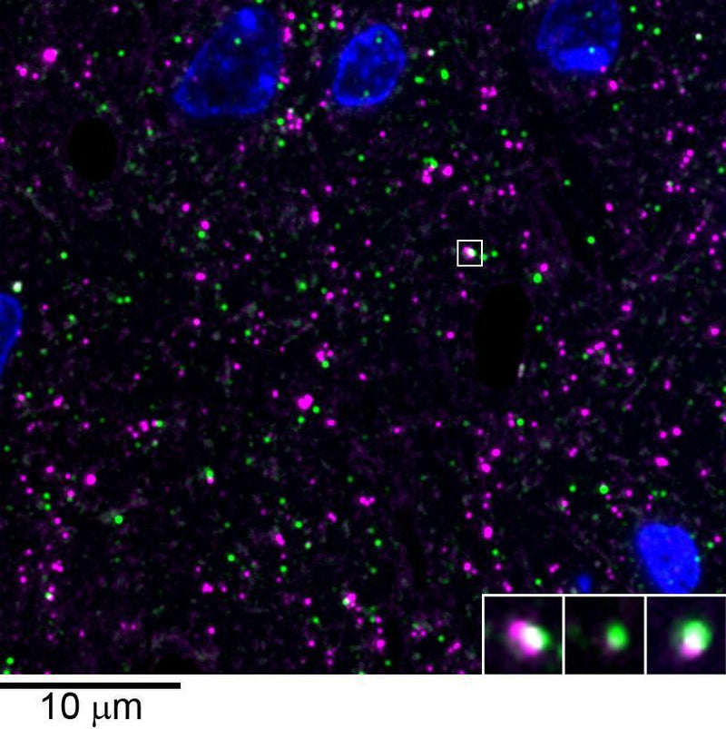 Array tomography immunofluorescence of a Lowicryl-embedded 70 nm section from adult mouse cortex with L120/12 (green), rabbit mAb GAD2 (Cell Signaling 5843, magenta) and DAPI (blue). The insert shows three consecutive sections through the synapse that is marked with a white box. Image courtesy of Kristina Micheva (Stanford).