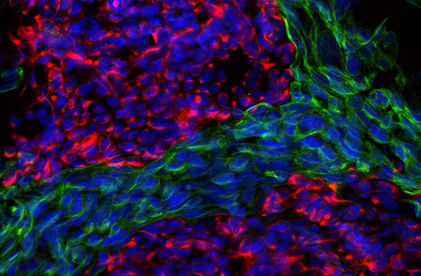 Immunoflourescence of mixed fibroblasts and PC12 cells labeled with anti-peripherin (cat. 1630-PER, red, 1:500) and anti-vimentin (cat. 2105-VIM, green, 1:10,000). The blue is Hoechst staining nuclear DNA. Peripherin is labeled in only the PC12 cells cytoplasmic filaments and vimentin is only labeled in the fibroblasts intermediate filaments where peripherin is not present.