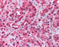 Immunohistochemistry of Formalin-Fixed Paraffin-Embedded (FFPE) prostate cancer cells showing specific staining of TRPM8. 