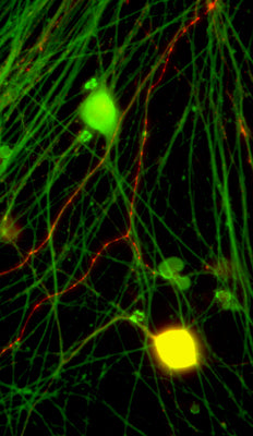 Immunostaining of CGRP (red) in cryopreserved DRG neurons grown on coverslips. 40xmag. Green staining is PGP9.5. Yellow staining is the colocalization of CGRP and PGP9.5. Cells were obtained and photo was provided courtesy of QBMCellScience.