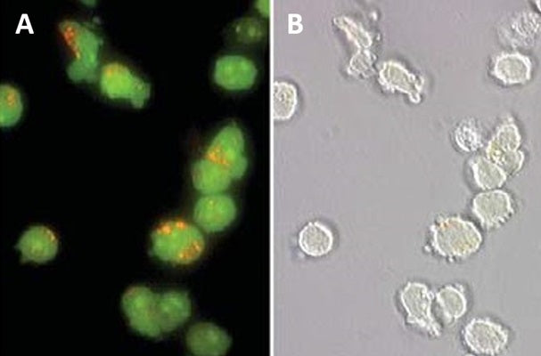 Figure 1. Normal Jurkat cells stained with Acridine Orange (AO) show orange lysosomal staining. Cells were stained with 5 µM AO in PBS for 60 minutes at 37°C. Photomicrographs were taken using a Nikon Eclipse E800 photomicroscope using a 460-500 nm excitation filter and a 505-560 nm emission / barrier filter set at 300X. Photo B shows the corresponding DIC image of the cells in A (AO appears faintly). Data courtesy of Dr. Zbigniew Darzynkiewicz (Brander Cancer Research Institute, New York, NY).