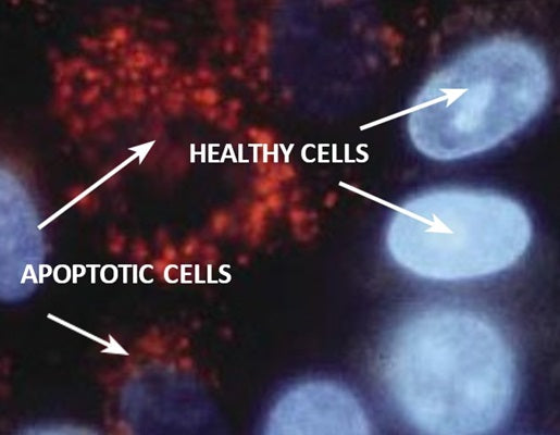 Figure 3. MCF-7 cells were exposed to 0.15 µM camptothecin (6210) for 24 hours at 37°C, then stained with MR-(DEVD)2 for 30 minutes at 37°C, washed, and then stained with 1 µg/mL Hoechst stain. Apoptotic cells with orange-red lysosomal bodies and less intense blue nuclei are intermixed with non-apoptotic cells bearing bright blue nuclei and absent or reduced orange-red lysosomal staining. Photo provided by Dr. Zbigniew Darzynkiewicz at Brander Cancer Research Center Institute, New York, NY.