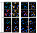 iPSC-DA neuronal cultures from control and LRRK2R1441C patient lines were treated with DMSO or CCCP (24 h, 10 μM) then fixed, stained for LRRK2 (Cat. 75-253, 1:100), TOM20 and MIRO1. Image from publication CC-BY-4.0. PMID:37384414