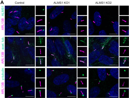 ALMS1 KO1 (p.Glu2462Glyfs∗8, p.Ser2846Argfs∗10), ALMS1 KO2 (p.Asp2458Argfs∗7, p.Ser2846Lysfs∗38) and control hTERT-RPE1 cells were stained for ARL13B (cilia, cat. 75-287, 1:500; magenta) and ALMS1, acetylated tubulin or γ-tubulin (green). In control cells, ALMS1 was detected at the basal body. In the two ALMS1 KO cell lines ALMS1 was lost at the cilium. No difference was observed for ARL13B, acetylated tubulin and γ-tubulin compared to control. DAPI is marked in blue. CC-BY-4.0. PMID:38122899
