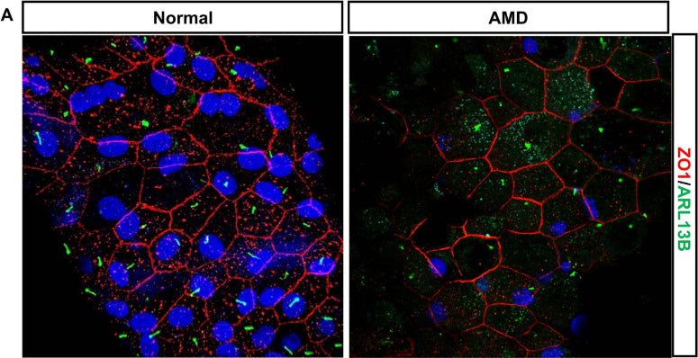 Confocal images stained for Arl13b (cat. 75-287, 1:2000; green) and ZO-1 (red) of healthy human RPE and AMD patient. Image from publication CC-BY-4.0. PMID:37211572