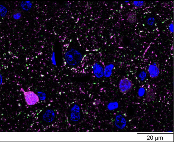 Array tomography immunofluorescence of an Lowicrylembedded 70 nm section from adult mouse neocortex with L127/8 (green), guinea pig polyclonal GABA (Millipore AB175, magenta) and DAPI (blue). Image courtesy of Kristina Micheva (Stanford).
