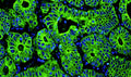 Immunofluorescent staining for detection of cytoskeleton in human colon cancer tissue using Aves Labs anti-Cytokeratin 8 (CK8) chicken recombinant monoclonal antibody (Cat No. 78-602) at 1:1000 dilution. This section of formalin fixed, paraffin embedded colon cancer tissue was blocked with Immuno Protein Blocking Solution with 5% Goat Serum (AR-6591-04). After washing with TBST, the tissue was stained using goat anti-chicken IgY FITC conjugated secondary antibody (Cat No. 80-1000-FITC) (green). The tissue was mounted with Antibodies Incorporated Fluoroshield with DAPI and DABCO mounting medium (Cat No. AR-6505). DAPI nuclear stain (blue) shows cell nuclei. Magnification 400X.