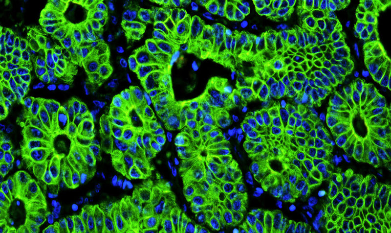 Immunofluorescent staining for detection of cytoskeleton in human colon cancer tissue using Aves Labs anti-Cytokeratin 8 (CK8) chicken recombinant monoclonal antibody (Cat No. 78-602) at 1:1000 dilution. This section of formalin fixed, paraffin embedded colon cancer tissue was blocked with Immuno Protein Blocking Solution with 5% Goat Serum (AR-6591-04). After washing with TBST, the tissue was stained using goat anti-chicken IgY FITC conjugated secondary antibody (Cat No. 80-1000-FITC) (green). The tissue was mounted with Antibodies Incorporated Fluoroshield with DAPI and DABCO mounting medium (Cat No. AR-6505). DAPI nuclear stain (blue) shows cell nuclei. Magnification 400X.