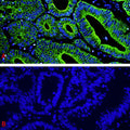 Immunofluorescent staining for detection of cytoskeleton in human colon cancer tissue using Aves Labs anti-Cytokeratin 8 (CK8) chicken recombinant monoclonal antibody (Cat No. 78-602) at 1:1000 dilution (Image A). Image B depicts the absence of staining in a secondary only control. The sections of formalin fixed, paraffin embedded colon cancer tissue were blocked with Immuno Protein Blocking Solution with 5% Goat Serum (AR-6591-04). After washing with TBST, the tissues were stained using goat anti-chicken IgY FITC conjugated secondary antibody (Cat No. 80-1000-FITC) (green). The tissues were mounted with Antibodies Incorporated Fluoroshield with DAPI and DABCO mounting medium (Cat No. AR-6505). DAPI nuclear stain (blue) shows cell nuclei. Magnification 400X.