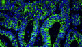 Immunofluorescent staining for detection of cytoskeleton in human colon cancer tissue using Aves Labs anti-E-Cadherin chicken recombinant monoclonal antibody (Cat No. 78-608) at 1:1000 dilution. This section of formalin fixed, paraffin embedded colon cancer tissue was blocked with Immuno Protein Blocking Solution with 5% Goat Serum (AR-6591-04). After washing with TBST, the tissue was stained using goat anti-chicken IgY FITC conjugated secondary antibody (Cat No. 80-1000-FITC) (green). The tissue was mounted with Antibodies Incorporated Fluoroshield with DAPI and DABCO mounting medium (Cat No. AR-6505). DAPI nuclear stain (blue) shows cell nuclei. Magnification 400X.
