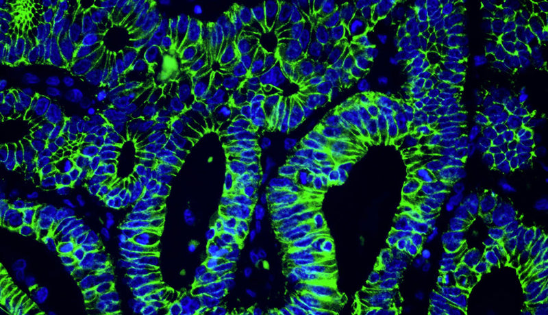 Immunofluorescent staining for detection of cytoskeleton in human colon cancer tissue using Aves Labs anti-E-Cadherin chicken recombinant monoclonal antibody (Cat No. 78-608) at 1:1000 dilution. This section of formalin fixed, paraffin embedded colon cancer tissue was blocked with Immuno Protein Blocking Solution with 5% Goat Serum (AR-6591-04). After washing with TBST, the tissue was stained using goat anti-chicken IgY FITC conjugated secondary antibody (Cat No. 80-1000-FITC) (green). The tissue was mounted with Antibodies Incorporated Fluoroshield with DAPI and DABCO mounting medium (Cat No. AR-6505). DAPI nuclear stain (blue) shows cell nuclei. Magnification 400X.