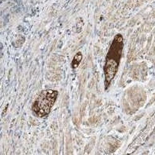 Immunohistochemistry detection of APC-AAT complexes, neoepitope in human fallopian tube tissue using Anti-APC-AAT Complexes, Neoepitope Antibody (Cat. ABS 001-07-010). Tissue was mounted and pariffin fixed. Heat induced antigen retrieval was performed using citrate buffer, heated, and then blocked. After washing, the primary antibody (Cat. ABS 001-07-010) was incubated with the sample.
