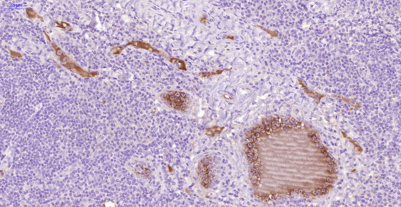 Immunohistochemistry detection of TAT (Thrombin-antithrombin) in human tonsil tissue using Anti-TAT (Thrombin-antithrombin) Antibody (Cat. ABS 014-22-010). Tissue was mounted and pariffin fixed. Heat induced antigen retrieval was performed using citrate buffer, heated, and then blocked. After washing, the primary antibody (Cat. ABS 014-22-010) was incubated with the sample at a dilution of 1:30. Moderate staining intensity of the plasma of the veins.
