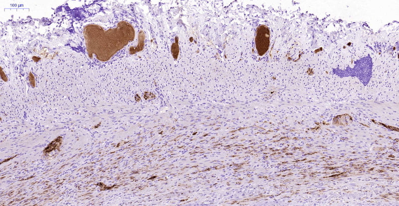 Immunohistochemistry detection of Peptide Histidine Methionine in human appendix tissue using Anti-Peptide Histidine Methionine Antibody (Cat. ABS 020-03-010). Tissue was mounted and pariffin fixed. Heat induced antigen retrieval was performed using citrate buffer, heated, and then blocked. After washing, the primary antibody (Cat. ABS 020-03-010) was incubated with the sample at a dilution of 1:200. Plasma of the veins stained strongly as well as ganglion cells of neuronal plexuses and neuronal axons.
