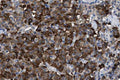 Immunohistochemistry detection of Leptin in human malignant carcinoid tissue using Anti-Leptin Antibody (Cat. ABS 022-03-010). Tissue was mounted and pariffin fixed. Heat induced antigen retrieval was performed using citrate buffer, heated, and then blocked. After washing, the primary antibody (Cat. ABS 022-03-010) was incubated with the sample.