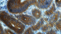 Chromogenic IHC validation: Colon Cancer FFPE sections. Primary antibody: Cytokeratin (Cat. MM-1023) antibody shown staining the epithelial cells. Secondary Antibody, HRP-anti mouse and Rat (Cat. IH-8061). The chromogenic substrate DAB which react with HRP and produce a brown chromogenic signal. Counter stain Hematoxylin, stains the nuclei in purple-blue. The sections were mounted using Immunohistomount (Cat. AR-6503).