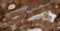 Chromogenic IHC validation: Colon Cancer FFPE sections. Primary antibody: Cytokeratin (Cat. MM-1023) antibody shown staining the epithelial cells. Secondary Antibody, HRP-anti mouse and Rat (Cat. IH-8061). The chromogenic substrate DAB which react with HRP and produce a brown chromogenic signal. Counter stain Hematoxylin, stains the nuclei in purple-blue. The sections were mounted using Immunohistomount (Cat. AR-6503).