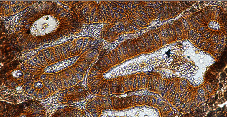 Chromogenic IHC validation: Colon Cancer FFPE sections. Primary antibody: Cytokeratin (Cat. MM-1023) antibody shown staining the epithelial cells. Secondary Antibody, HRP-anti mouse and Rat (Cat. IH-8061). The chromogenic substrate DAB which react with HRP and produce a brown chromogenic signal. Counter stain Hematoxylin, stains the nuclei in purple-blue. The sections were mounted using Immunohistomount (Cat. AR-6503).