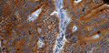 Chromogenic IHC validation: Colon Cancer FFPE sections. Primary antibody: Cytokeratin (Cat. MM-1023) antibody shown staining the epithelial cells. Secondary Antibody, HRP-anti mouse and Rat (Cat. IH-8061). The chromogenic substrate DAB which react with HRP and produce a brown chromogenic signal. Counter stain Hematoxylin, stains the nuclei in purple-blue. The sections were mounted using Immunohistomount (Cat. AR-6503).
