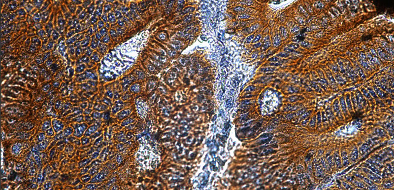 Chromogenic IHC validation: Colon Cancer FFPE sections. Primary antibody: Cytokeratin (Cat. MM-1023) antibody shown staining the epithelial cells. Secondary Antibody, HRP-anti mouse and Rat (Cat. IH-8061). The chromogenic substrate DAB which react with HRP and produce a brown chromogenic signal. Counter stain Hematoxylin, stains the nuclei in purple-blue. The sections were mounted using Immunohistomount (Cat. AR-6503).