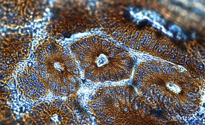 Chromogenic IHC validation: Colon Cancer FFPE sections. Antigen retriever used Citrate Buffer, pH 6.0 (Cat. AR-6544). Primary antibody: Cytokeratin (Cat. MM-1023) antibody shown staining the epithelial cells. Secondary Antibody, HRP-anti mouse and Rat (Cat. IH-8061). The chromogenic substrate DAB which react with HRP and produce a brown chromogenic signal. Counter stain Hematoxylin, stains the nuclei in purple-blue. The sections were mounted using Immunohistomount (Cat. AR-6503).