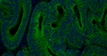 Fluorescent IHC validation: Colon Cancer FFPE sections. Primary antibody: Cytokeratin (Cat. MM-1023) antibody shown staining the epithelial cells (Green). Secondary Antibody, Goat anti- mouse 488 (Cat. 80-2001-488). The sections were mounted using Fluoroshield with DAPI and DABCO (DAPI stains nucleus in blue) (Cat. AR-6505).