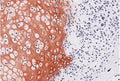 Immunohistochemistry detection of Procollagen type IIA N-terminal propeptide (PIIANP) in human chondroblastoma tissue using Anti-Procollagen Type IIA N-terminal Propeptide (PIIANP) Antibody (Cat. BTE 003-02-010). Tissue was mounted and pariffin fixed. Heat induced antigen retrieval was performed using citrate buffer, heated, and then blocked. After washing, the primary antibody (Cat. BTE 003-02-010) was incubated with the sample.