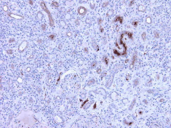 Immunohistochemistry detection of Complement C4c in human kidney tissue using Anti-Complement C4c Antibody (Cat. CAM 072-18-010). Tissue was mounted and pariffin fixed. Heat induced antigen retrieval was performed using citrate buffer, heated, and then blocked. After washing, the primary antibody (Cat. CAM 072-18-010) was incubated with the sample at a dilution of 1:600. Strong staining of veins of nephritis kidney.