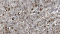 Immunohistochemistry detection of Vitronectin in human cancerous liver tissue using Anti-Vitronectin Antibody (Cat. CSI 003-02-010). Tissue was mounted and pariffin fixed. Heat induced antigen retrieval was performed using citrate buffer, heated, and then blocked. After washing, the primary antibody (Cat. CSI 003-02-010) was incubated with the sample.
