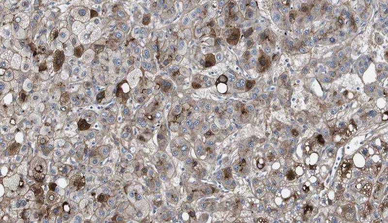 Immunohistochemistry detection of Vitronectin in human cancerous liver tissue using Anti-Vitronectin Antibody (Cat. CSI 003-02-010). Tissue was mounted and pariffin fixed. Heat induced antigen retrieval was performed using citrate buffer, heated, and then blocked. After washing, the primary antibody (Cat. CSI 003-02-010) was incubated with the sample.