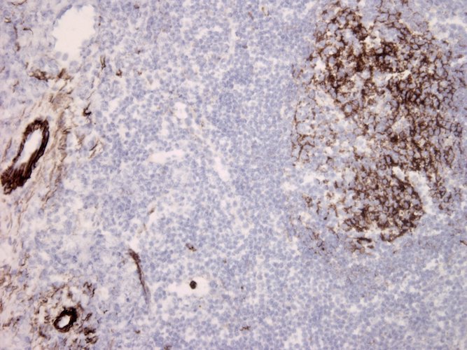 Immunohistochemistry detection of Complement C5b-9 in human tonsil tissue using Anti-Complement C5b-9 Antibody (Cat. DIA 011-01-010). Tissue was mounted and pariffin fixed. Heat induced antigen retrieval was performed using citrate buffer, heated, and then blocked. After washing, the primary antibody (Cat. DIA 011-01-010) was incubated with the sample at a dilution of 1:10. Vascular endothelia and dendritic cells of germinal center have strong and intensive label.