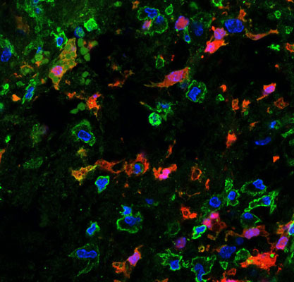 Immunostaining of MBP (red, 1:200), CD45(green, 1:100), and DAPI (1:1000, nuclei) of a mouse spinal cord lysophosphatidylcholine lesion. Image kindly provided by Charbel Baaklini, Neuroscience and Mental Health Institute, University of Alberta, Edmonton, Canada. 