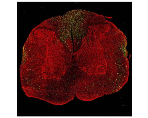 Image of a rat spinal cord section with a three-day-old midline C4 contusion injury by Immunofluorescence and Immunohistochemistry. The section was stained with C-2125-100, Neurofilament light polypeptide (NF-L), DG-Sensor™, Chicken pAb, (green), and co-stained with product R-2113-50, Neurofilament light polypeptide, C-terminus, (NF-L-Ct), Rabbit pAb, (red). Product C-2125-100 stains prominent aggregates of material concentrated in the lateral funiculi and dorsal columns, which are degenerating and degenerated axons caused by the C4 lesion. As product R-2113-50 antibody binds the C-terminal "tail" region of NF-L, which is absent or destroyed during degeneration, the DG-Sensor™ C-2125 stains positively for degenerating NF-L profiles, but staining with R-2113-50 full-length NF-L is largely negative.