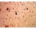 Mouse monoclonal antibody to Ubiquitin [Ubi-1] M-1404-100 staining of cerebral cortex of an Alzheimer patient. Neurofibrillary tangles and dystrophic neurites associated with senile plaques stain strongly with this antibody. In the center is a typical neurofibrillary tangle containing neuron.