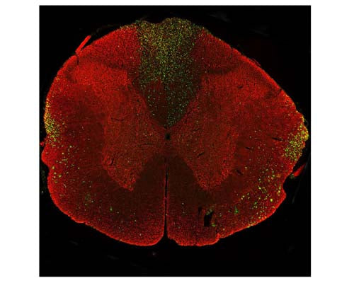 Image of a rat spinal cord coronal section with a three-day-old midline C4 contusion injury by Immunofluorescence and Immunohistochemistry. The section was stained with M-2122-50, Neurofilament light polypeptide (NF-L), DG-Sensor™, Clone 6H63, Mouse mAb, (green), and co-stained with product R-2113-50, Neurofilament light polypeptide, C-terminus, (NF-L-Ct), Rabbit pAb, (red). Product M-2122-50 stains prominent material aggregates in the lateral funiculi and dorsal columns, where the material is concentrated but less so elsewhere in the section. Due to the C4 lesion, these axons are deteriorating and dying. As product R-2113-50 binds to the C-terminal "tail" region of NF-L, which is absent or destroyed during degeneration, only M-2122-50 staining is observed in the degenerating neurons; positive staining for R-2113-50 in those regions is largely negative.