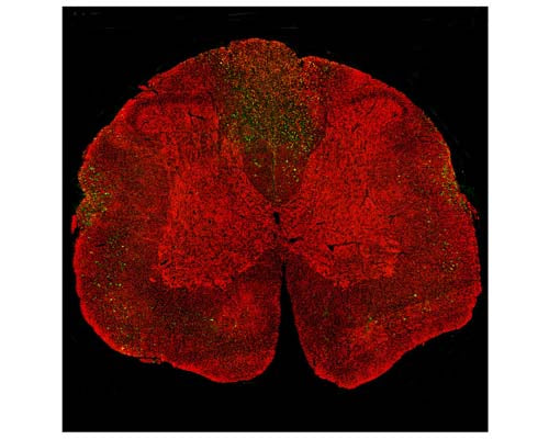 Image of a rat spinal cord section with a three-day-old midline C4 contusion injury by Immunofluorescence and Immunohistochemistry. The section was stained M-2128-100, Neurofilament light polypeptide (NF-L), Clone 1B11, Mouse mAb, (green), and co-stained with product R-2113-50, Neurofilament light polypeptide, C-terminus, (NF-L-Ct), Rabbit pAb, (red). Product M-2128-100 stains prominent aggregates of material concentrated in the lateral funiculi and dorsal columns, which are degenerating and degenerated axons caused by the C4 lesion. As product R-2113-50 antibody binds the C-terminal "tail" region of NF-L, which is absent or destroyed during degeneration, product M-2128-100 stains positively for degenerating NF-L profiles, but staining with R-2113-50 full-length NF-L is largely negative.