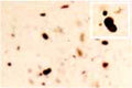 IHC detection of cortical Lewy Bodies (inclusions) and Lewy neurites from a patient with Dementia Lewy Bodies. Primary antibody was Rabbit antibody to alpha synuclein (129-140): whole serum (R-075-100) at a dilution of 1:1000, visualised with Avidin-Biotin-Peroxidase and DAB.