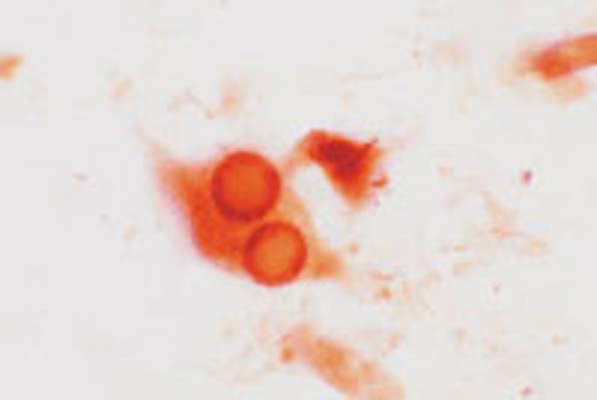 Immunohistochemical staining of synphilin-1 positive Lewy bodies in dorsal rache nucleus in a case of Parkinson's disease using rabbit polyclonal antibody to human synphilin-1, catalogue number R-116-100.