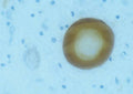 Immunohistochemical staining of lewy body in Parkinsons diseased human brain tissue using sheep polyclonal to human alpha synuclein, catalogue number S-075-50.