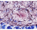 Bright field illumination (60X mag) of 8 month old Ad-Tg mouse hippocampus. The myelin pathology can be observed in and around amyloid plaques. The cell bodies of adjacent granule and polymorph cells appear blue, while individual myeliated fibres appear nearly black. Photo is courtesy of Dr. Larry Schmued.