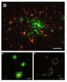 D: Within the CA4 region of the hippocampus, co-labeling using GFAP antibody demonstrates the relationship between hypertrophied astrocytes (orange) and the amyloid plaques (green) that they typically surround. GFAP-immunoreactivity was visualized with TRITC fluorophore. E: Three amyloid plaques (green) are seen in the cortex of a human with Alzheimer's disease. F: An example of vascular plaques in the cortex of a human AD patient.