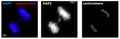 A microscopy image of a cell from BJ hTERT cell line treated with aphidicolin to induce genomic instability. Immunolabeling of the cell positively labelling CREST/Centromere Protein (red, 1:500,  Cat No. 15-234) and labelling DNA with DAPI. The anaphase cell has a segregation error which lacks centromeric staining unlike the mass