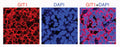 Sliced human breast tumor was stained using Anti-GIT1 antibody (NeuroMab, Cat. No. 75-094, Clone N39/8, 1000x), then followed by anti-Mouse IgG (H+L) secondary antibody, Alexa FluorTM (Invitrogen, A-21425) and DAPI for nuclei.