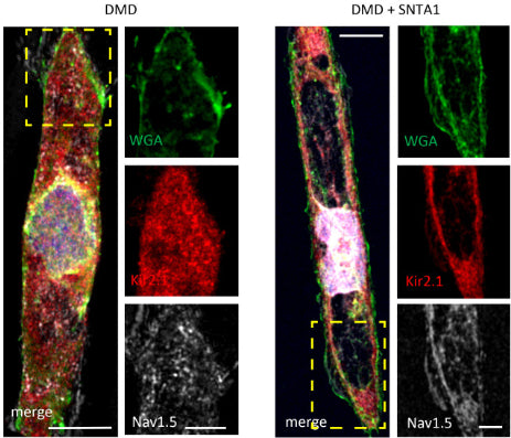 Immunostaining for Kir2.1 (red), NaV1.5 (white), and wheat germ agglutinin (WGA; green) in control Male 1 iPSC-CM (left) and Male 1 iPSC-CM transfected with SNTA1. Nuclei were stained with DAPI. Yellow arrows point to iPSC-CM membrane staining. Image from publication CC-BY-4.0. PMID: 35762211